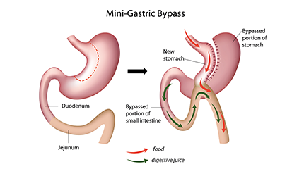 Prevalence of Mini-Gastric Bypass