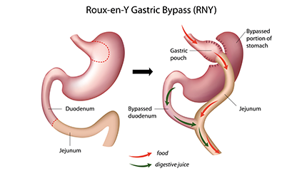 Roux-en-Y Gastric Bypass